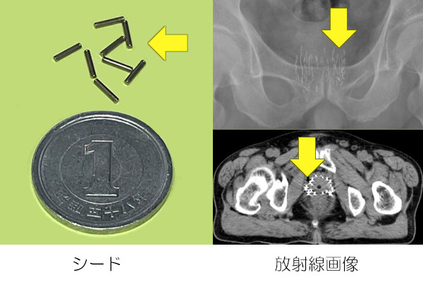 ブラキ療法で使う前立腺に埋め込むシード（放射線源）と埋め込み後の画像
